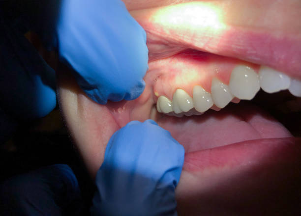 Best Broken or Chipped Tooth Repair in Pevely, MO